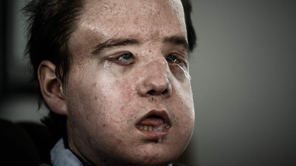 El “hombre de tres caras” que durante dos meses vivió sin rostro en un hospital