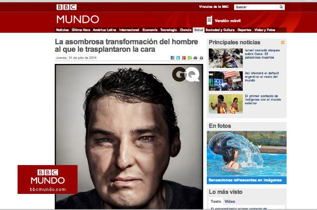 La asombrosa transformación del hombre al que le trasplantaron la cara