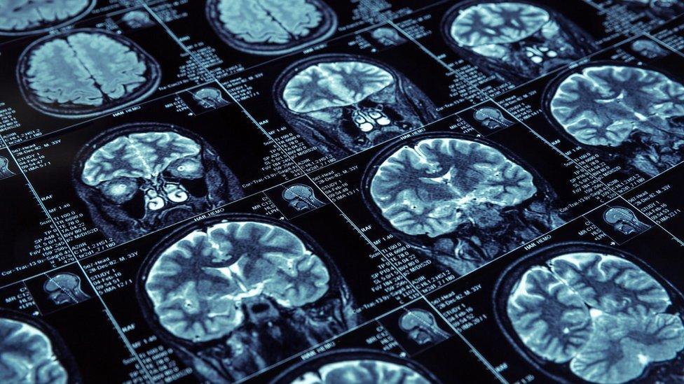 Qué es la mutación Jalisco y por qué es importante estudiarla para saber más sobre el Alzheimer