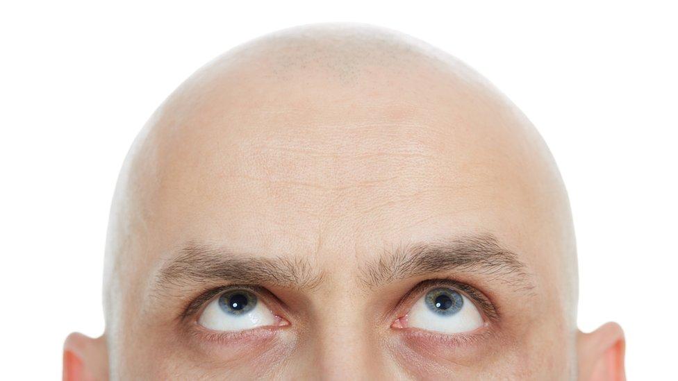 El efecto secundario de un fármaco para la osteoporosis que llena de esperanza a los calvos