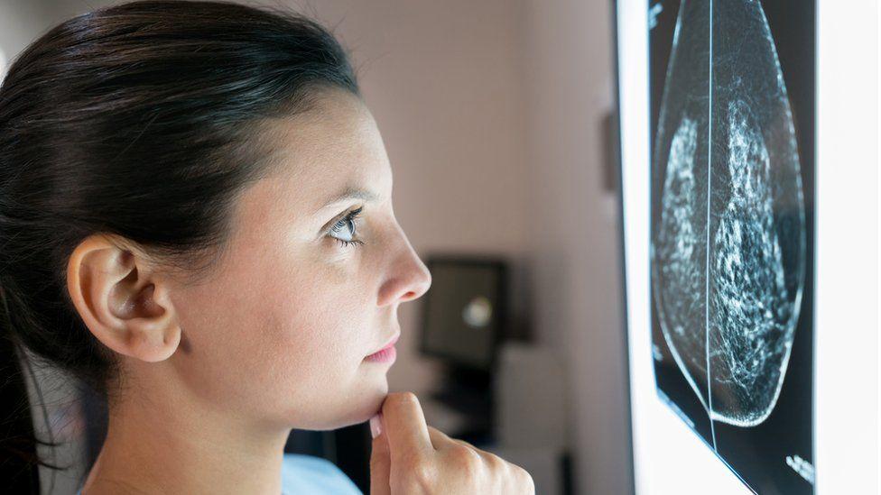 El modelo que permite predecir qué riesgo de recaída tiene un cáncer de mama