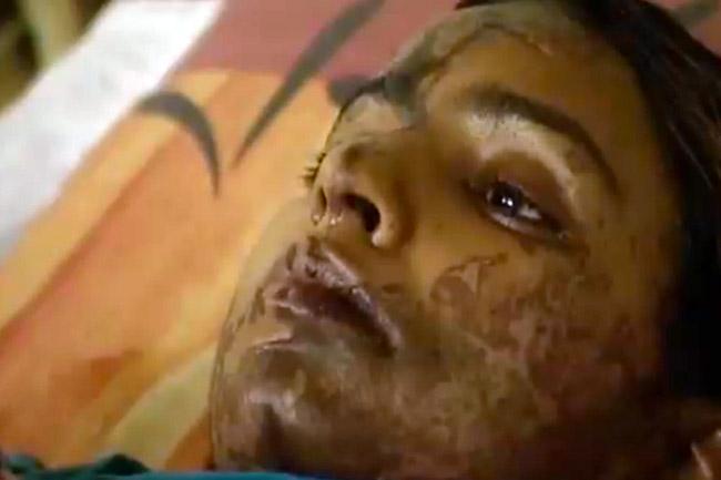 Mujeres quemadas con ácido, un crimen que no se castiga en Pakistán