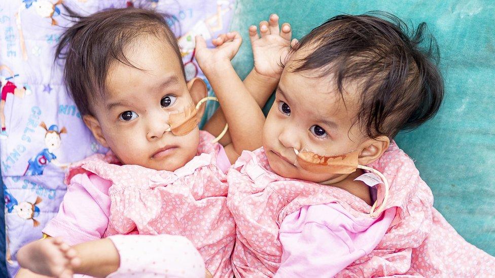 La exitosa operación para separar a gemelas siamesas de Bután en Australia