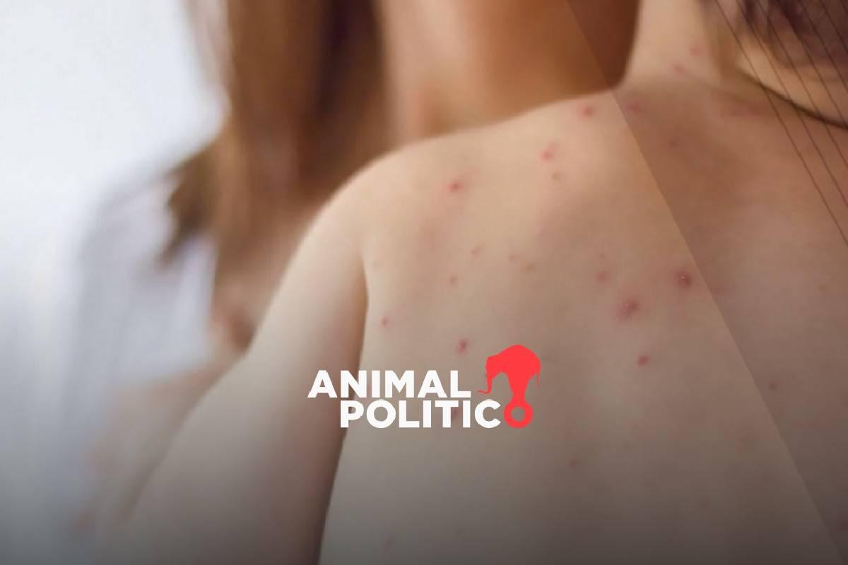 Brote de sarampión está confirmado en todos los estados; suman 7,131 casos