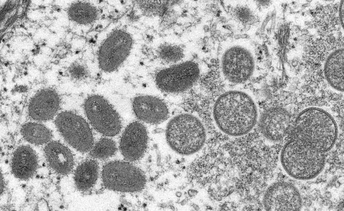 Edomex reporta dos casos de viruela del mono; pacientes están estables y en aislamiento
