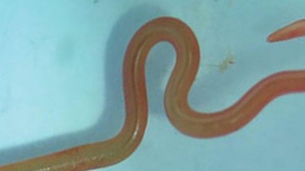 Investigadores encuentran por primera vez un gusano vivo en el cerebro de una mujer