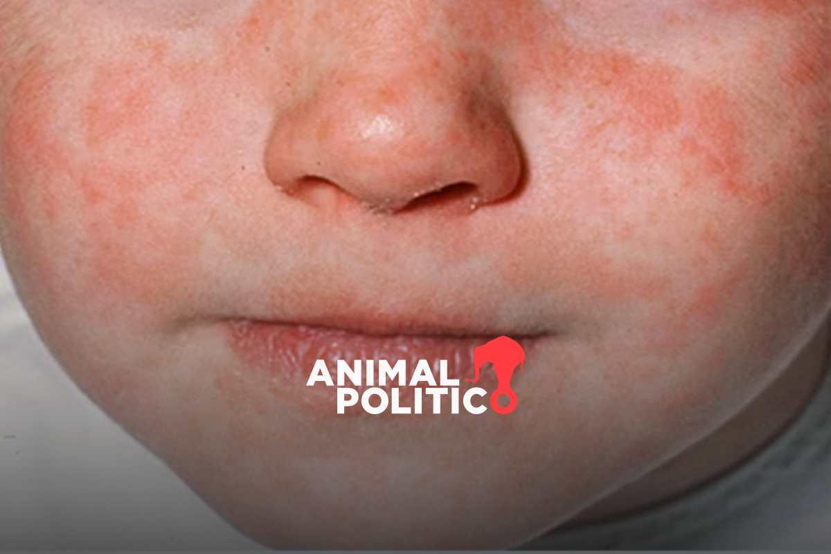 Salud emite aviso epidemiológico por casos de sarampión en México; hay 859 casos probables