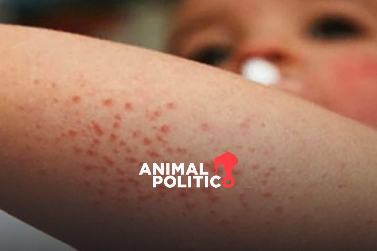 México confirma su primera muerte por sarampión en 2026; en 2025 se registraron 25