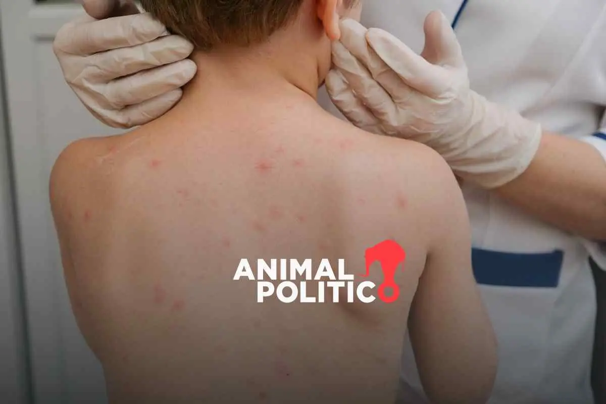 México registra 24 muertes por sarampión en 2025; Chihuahua, el estado con más registro de defunciónes